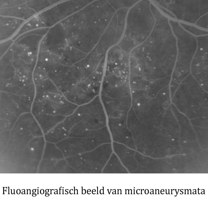 micronaneurysmata fluoangiografie