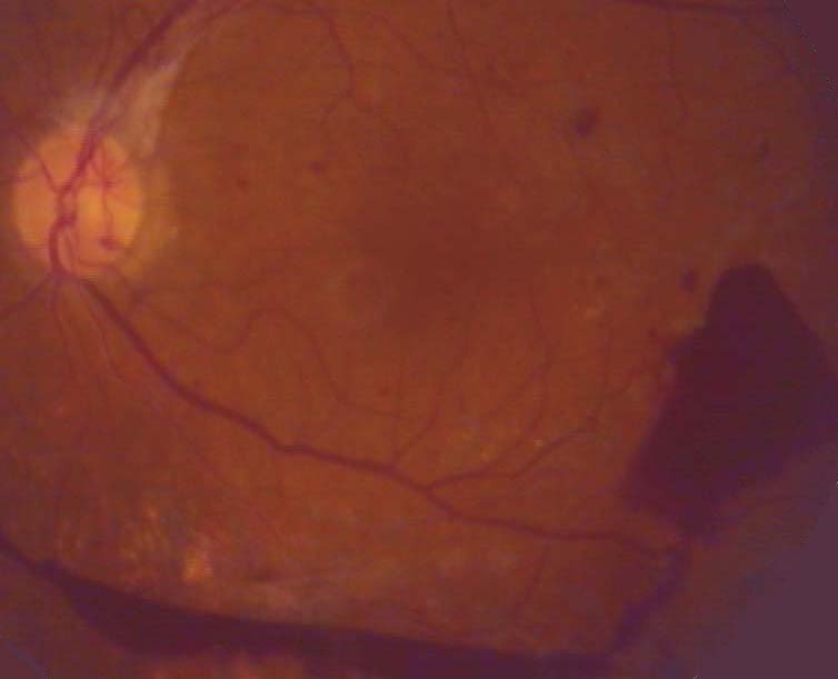 proliferatieve retinopathie met glasvochtbloeding