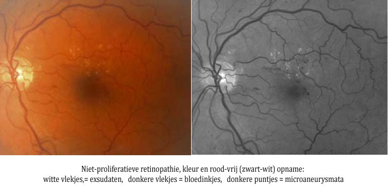 niet-proliferatieve retinopathie