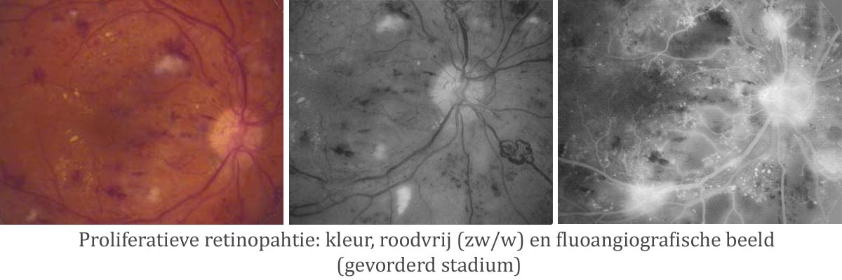 diabetes proliferatieve retinopathie